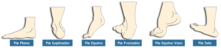 Diferentes tipos de pies que requieren plantillas ortopédicas personalizadas
