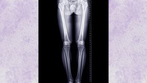 Lee más sobre el artículo Cómo Identificar y Tratar el Acortamiento de una Pierna con Plantillas Ortopédicas de Compensación