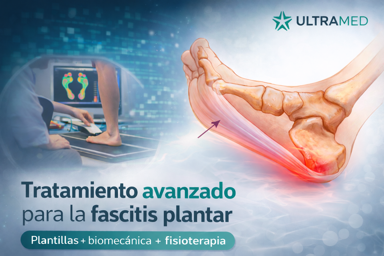 Tratamiento avanzado para la fascitis plantar en UltraMed con diagnóstico biomecánico y plantillas personalizadas